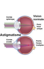 astigmatisme